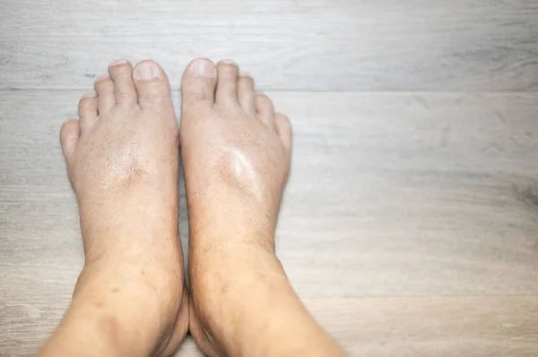 The feet of old man wrinkle skin swollen feet with the cancer and the body lack of the protein for health so not good. Fingers hit the back of the cancer foot. To test foot swelling.