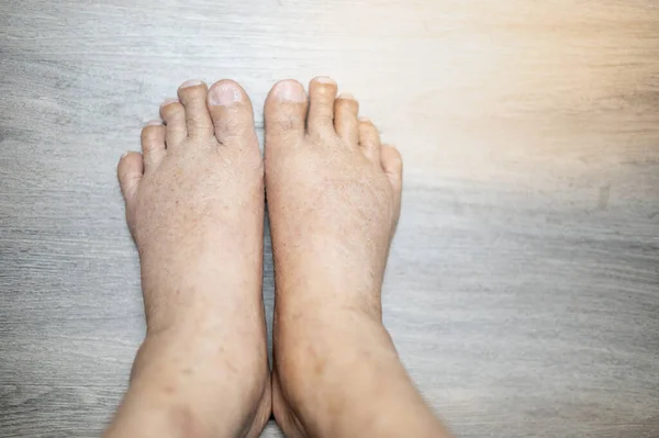 The feet of old man wrinkle skin swollen feet with the cancer and the body lack of the protein for health so not good.