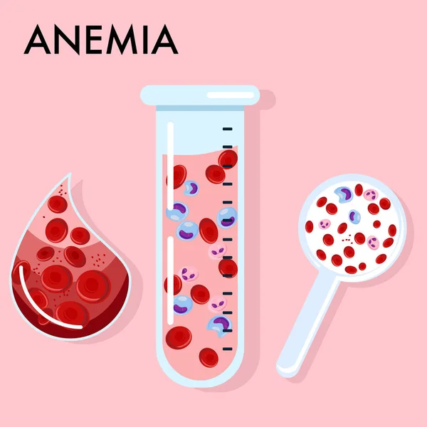 Concepto Anemia Tubo Laboratorio Vidrio Lupa Con Análisis Sangre Disminución — Vector de stock