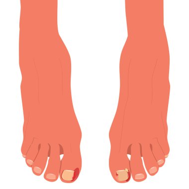 Feet with ingrown toenails.Disease, fungus or inflammation in fingernails. Legs problem area with pus and blood.Right pedicure,body care.Onychomycosis, paronychia sickness.Vector in flat style clipart