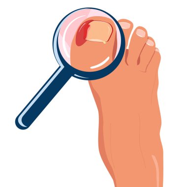 Foot with ingrown toenail.Disease, fungus or inflammation in fingernails. Magnifying glass zooming problem area with pus and blood.Right pedicure,body care.Onychomycosis, paronychia sickness.Vector clipart