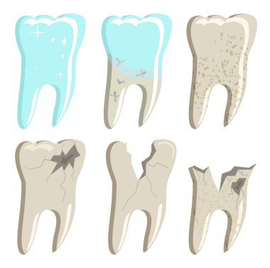 Different stages of decayed teeth with caries and plaque.Oral cavity disease.Root canal filling.Template for dentistry officeMolars with cracks and holes. Damaged enamel problems. Orthodontics clinic clipart