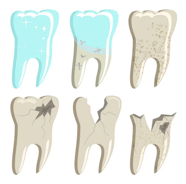 Diferentes Etapas Caries Placa Dental Enfermedad Cavidad Oral Relleno Del — Vector de stock