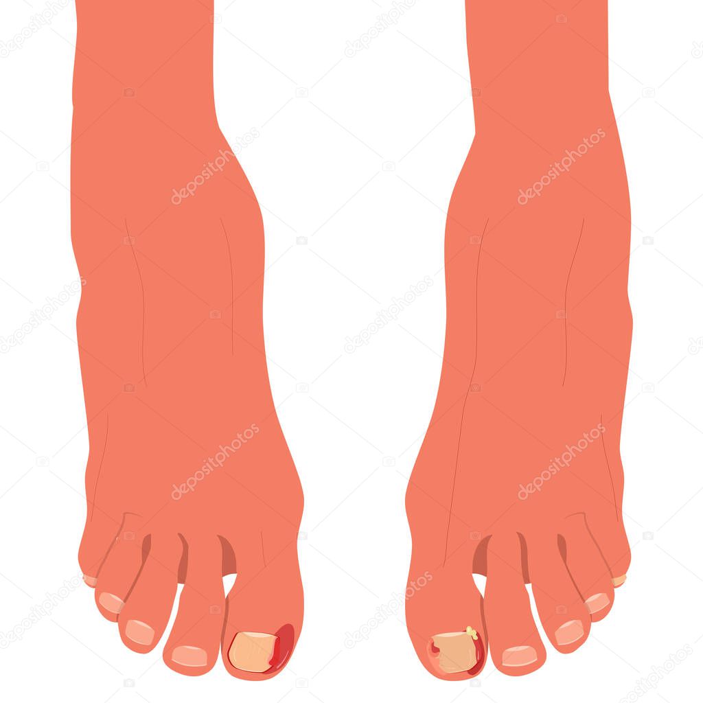 Feet with ingrown toenails.Disease, fungus or inflammation in fingernails. Legs problem area with pus and blood.Right pedicure,body care.Onychomycosis, paronychia sickness.Vector in flat style