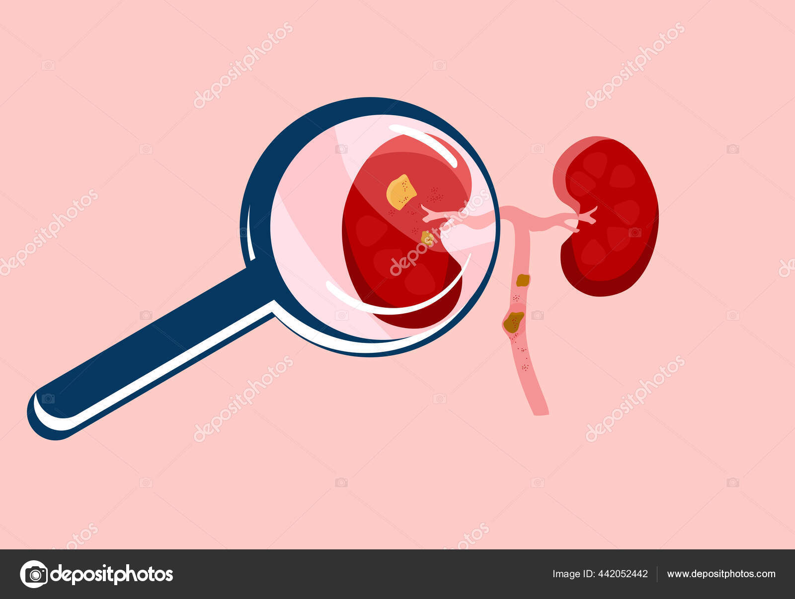 Scrutiny Kidney Stone Magnifying Glass Nephrology Pyelonephritis Renal  Failure Disease Stock Vector Image by © #442052442