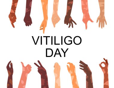 Dünya Vitiligo Günü posterleri. Deri hastalığıyla farklı etnik kökenleri el üstünde tutuyor. Dağıtım sorunu. Deri renginin yamalı kaybı. Beyaz noktalar. Otoimmün hastalık. İnsan Dayanışması.