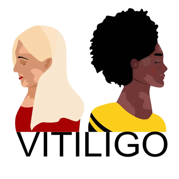 Día Mundial Del Vitiligo Mujeres Jóvenes Diferentes Etnias Con Enfermedades — Archivo Imágenes Vectoriales