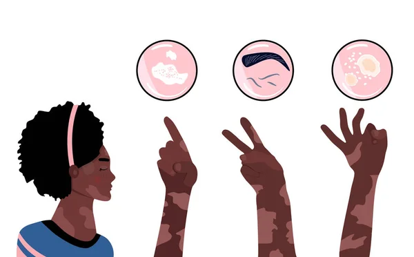 Världsomspännande Vitiligo Ung Afro Amerikansk Kvinna Med Hudsjukdom Händerna Visar — Stock vektor
