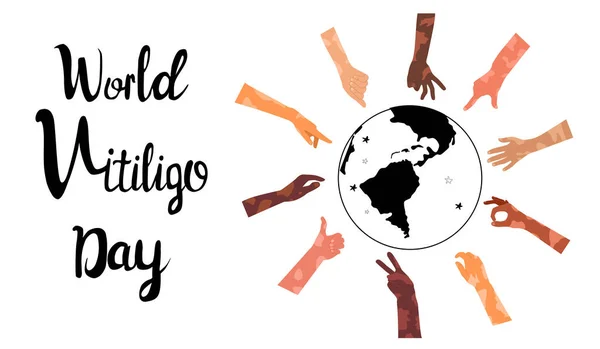 Světový Vitiligo Den Plakát Písmeny Ruce Různé Etniky Různých Gestech — Stockový vektor
