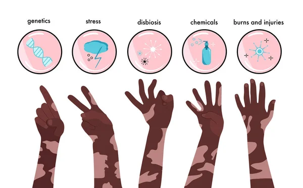 Día Mundial Del Vitiligo Iconos Infografías Con Motivos Enfermedad Manos — Vector de stock