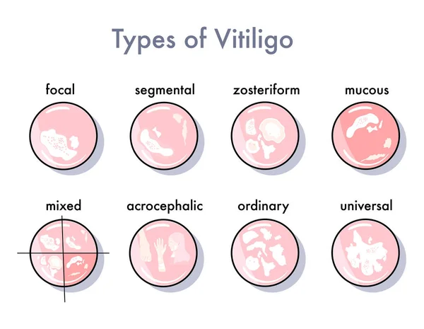 Tipos Iconos Infografía Del Vitiligo Opciones Para Propagación Manifestación Enfermedad — Vector de stock