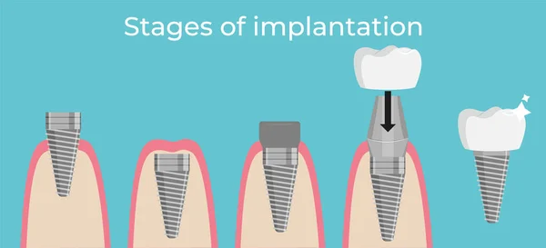 Stages of dental implant installation. Crowns veneers. Health care. Vector illustration.