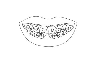 Continuous one line of teeth and braces in silhouette. Linear stylized.Minimalist.