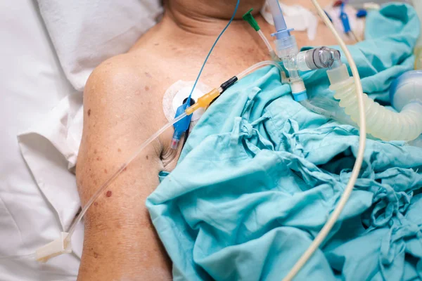 Patient asian elder woman 80s flu covid19 do tracheostomy use ventilator for respiration breathing help on patient bed in intensive care unit (ICU.) room at hospital in concept healthcare in life
