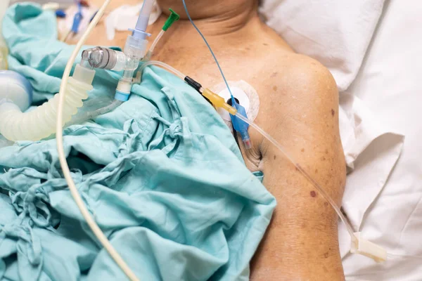 Patient asian elder woman 80s flu covid19 do tracheostomy use ventilator for respiration breathing help on patient bed in intensive care unit (ICU.) room at hospital in concept healthcare in life