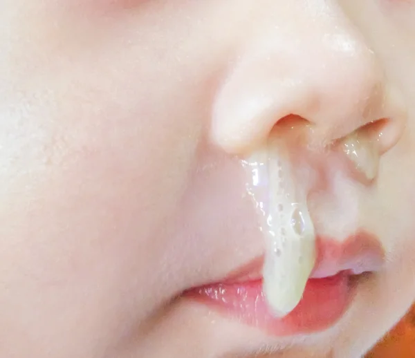 Mucus from nose of young boy — Stock Photo, Image