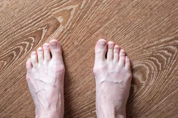 Piernas femeninas descalzas cansadas con venas sobresalientes sobre un fondo de madera, vista superior. Concepto de problemas de salud del pie —  Fotos de Stock