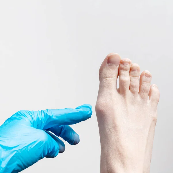 Χέρι σε ένα μπλε ιατρικό γάντι, ένας ορθοπεδικός χειρουργός εξετάζει ένα πόδι των γυναικών, εξέταση ποδιών — Φωτογραφία Αρχείου