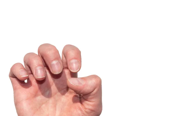 Крупный план слабых сломанных натуральных ногтей, лишенных питательных веществ, без маникюра на белом фоне — стоковое фото
