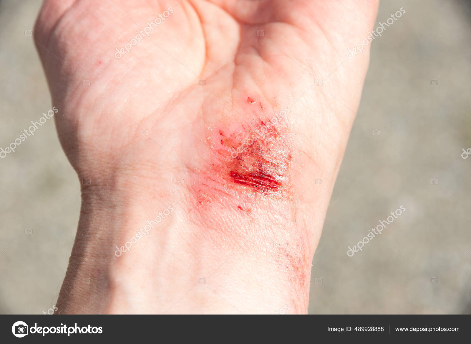 Bloody wound on the palm, arm, wrist after an accident or fall. Sport