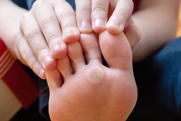 Ayak deride sorunlu bölgeler, kuru mısır. Ayakta ayak siğili var. Sağlıksız ayak derisi kavramı. Kozmetik ve cilt bakımı kavramı — Stok fotoğraf