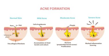 Sivilce oluşumunun aşamalarını gösteren çizimler