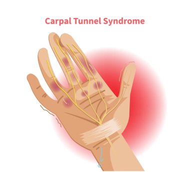 Karpal tünel sendromu etkilerini gösteren çizimler