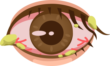 Kahverengi gözü tahriş ile kapat.