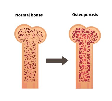 Normal kemik ve osteoporoz durumu