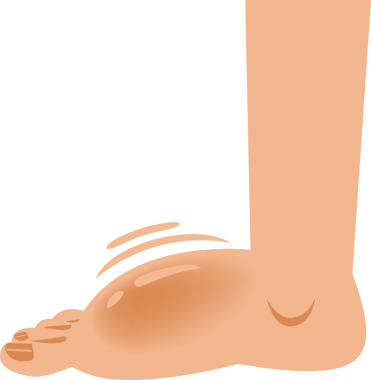 Ayak bileği ve ayak parmakları şişmiş.