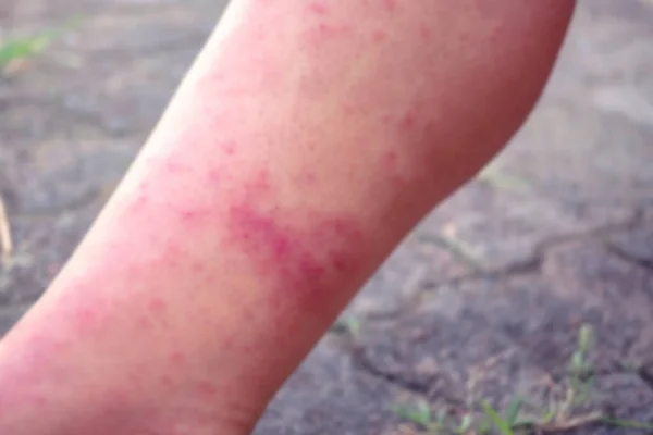 Suddiga Bilder För Dermatit Viral Dermatit Utslag Dermatit Klåda Urtikaria — Stockfoto