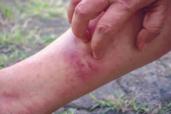 Wazige Beelden Tijdens Het Krabben Hands Dermatitis Virale Dermatitis Jeukende — Stockfoto