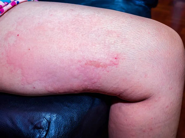 Skin disease on the body, viral skin disease Measles rash with dermatitis of Itching blister dermatitis Urticaria on body Health problem allergy symptoms Redness and peeling of the skin on the leg.