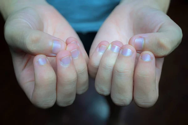 Показаны Характерные Укушенные Грязные Ногти Которые Требуют Срочного Лечения Грязные — стоковое фото