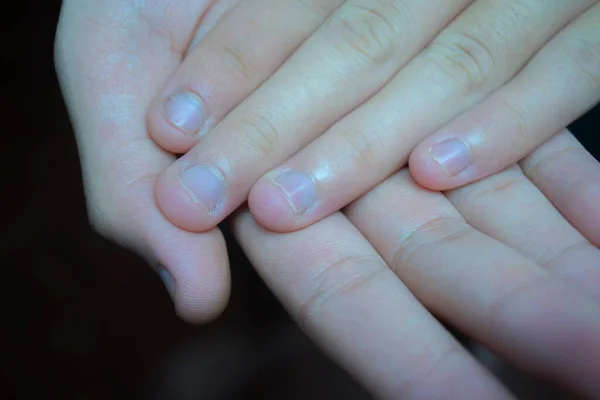 The condition of the nail that was bitten, placed on the palm of another person, the condition of the fingernail is not beautiful, not caused by being bitten.