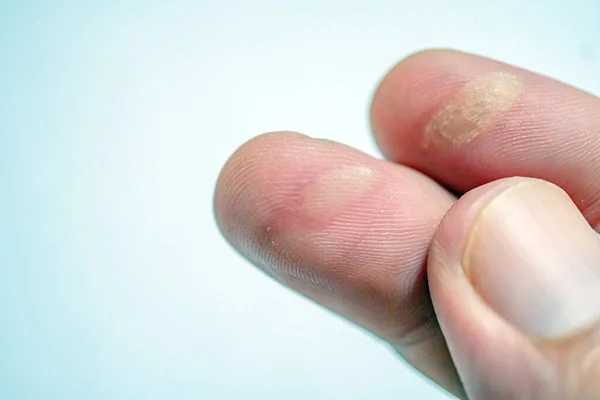 Обгоревшие Пальцы Огонь Пальцами Вызванный Халатностью Ожог Кожи Пальце — стоковое фото