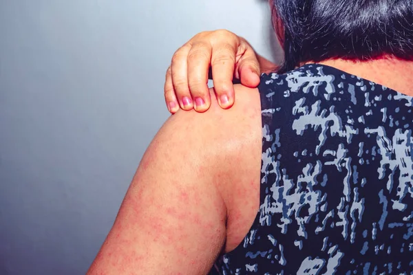 Een Vrouw Krassen Haar Schouder Met Een Hand Als Gevolg — Stockfoto