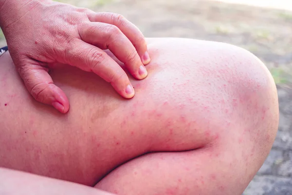 Menselijke Huid Met Rode Blaren Close Van Menselijke Huid Met — Stockfoto