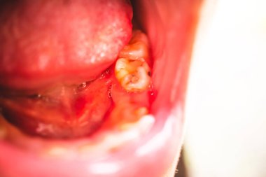 Çocuk bakıcılığı, çürük dişli çocuğun yakın çekimleri, ön dişler, çocuklarla ilgili bir sorun, aileler dişçiye gitmeli..