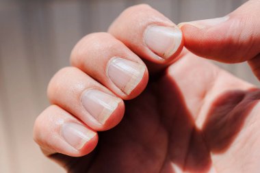 Çok kirli tırnaklar, kesilmiş tırnakları göster, acil müdahale gerektiriyor. Kirli tırnaklar ciddi bulaşıcı hastalıklara ve arka planda eksik maniküre neden olabilir. çok kirli tırnaklar..