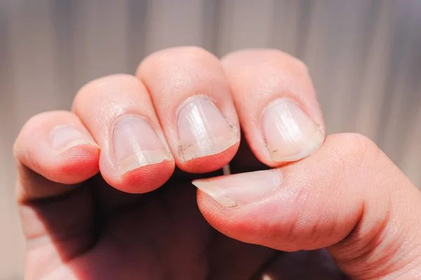 Грязные Ногти Могут Вызвать Серьезные Инфекционные Заболевания Неполный Маникюр Заднем Стоковое Фото