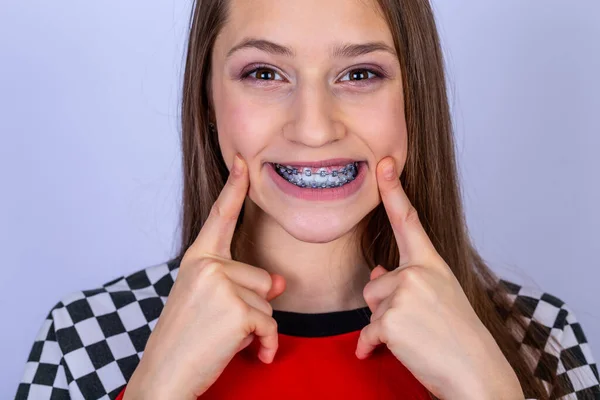 Nastolatek Uśmiechem Pokazuje Białe Zęby Aparatem Zęby Białe Tło — Zdjęcie stockowe