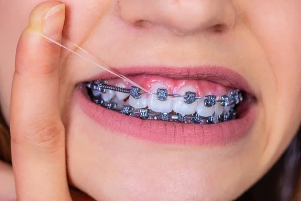 Primer Plano Retrato Una Adolescente Feliz Con Frenillos Hermosa Sonrisa — Foto de Stock