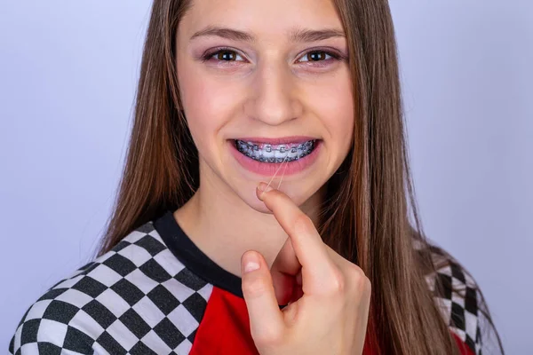 Adolescente Com Sorriso Mostra Dentes Brancos Com Aparelho Fundo Branco — Fotografia de Stock