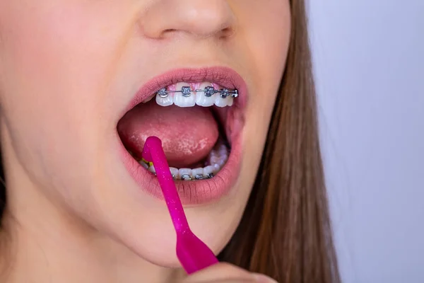 Concepto Dentista Ortodoncista Chica Con Aparatos Ortopédicos Limpiando Dientes Usando — Foto de Stock