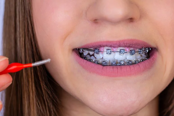 Conceito Dentista Ortodontista Menina Com Aparelho Limpeza Dentes Usando Escovas — Fotografia de Stock