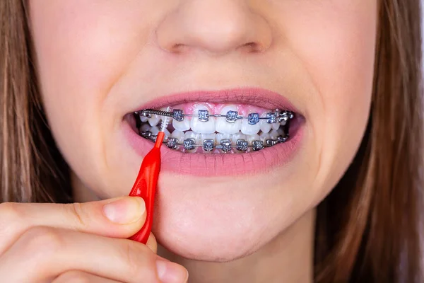 Concepto Dentista Ortodoncista Chica Con Aparatos Ortopédicos Limpiando Dientes Usando — Foto de Stock