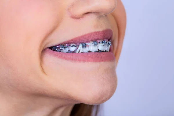 Primer Plano Retrato Una Adolescente Feliz Con Frenillos Hermosa Sonrisa — Foto de Stock