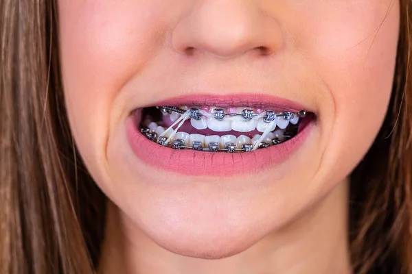 Nahaufnahme Porträt Eines Glücklichen Teenie Mädchens Mit Zahnspange Und Schönem — Stockfoto