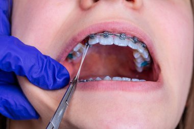 Ortodontist elleri kapatın ve hasta parantezlerine elastik lastik bantlar takın..